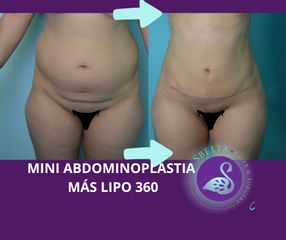 Mini Abdominoplastia más Lipo 360 - Dra. Jessica Ramírez Cadena