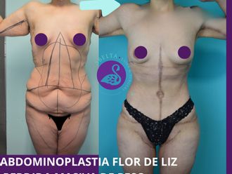 Abdominoplastia antes y después - 880206