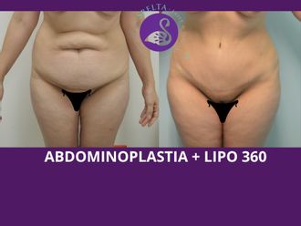 Abdominoplastia antes y después - 880207