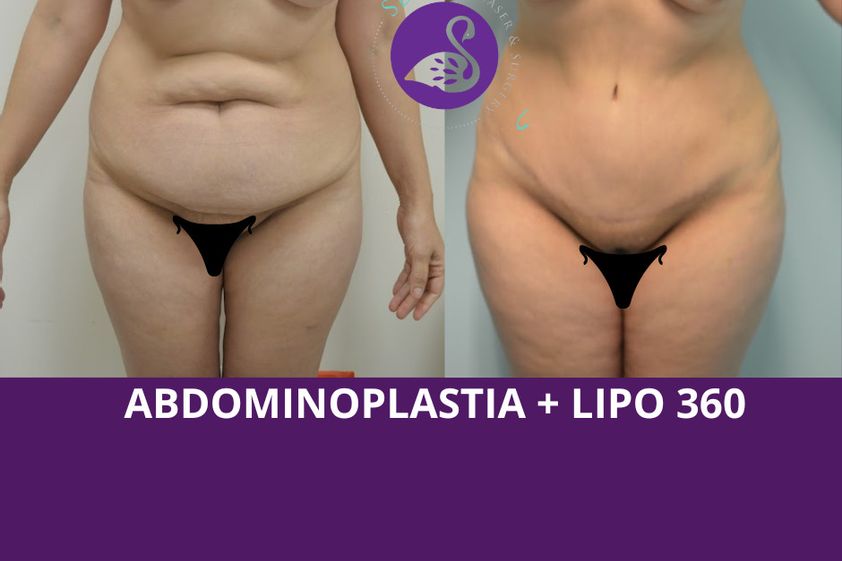 Abdominoplastia antes y después - 880207