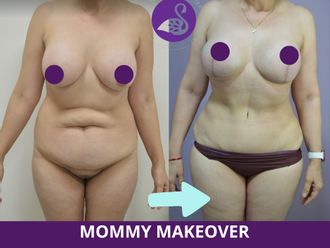 Mommy makeover antes y después - 880208