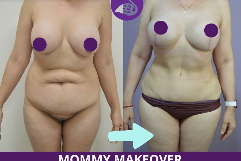 Mommy makeover antes y después - 880208