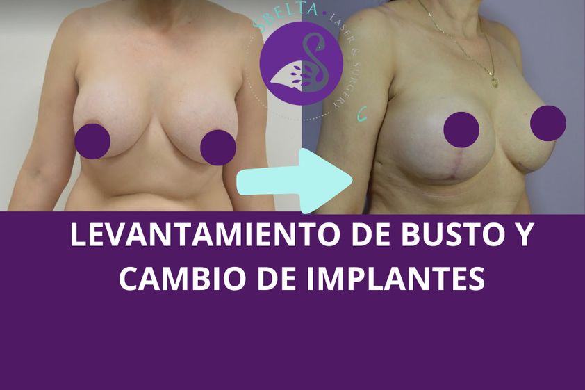 Aumento de busto antes y después - 880209