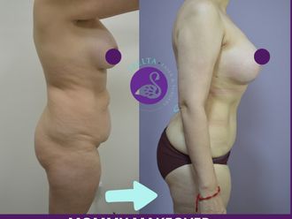 Mommy makeover antes y después - 880210