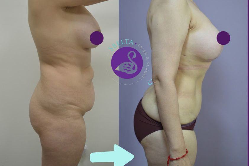 Mommy makeover antes y después - 880210