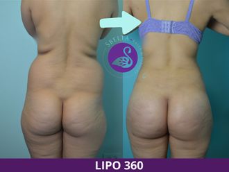 Lipoescultura antes y después - 880211