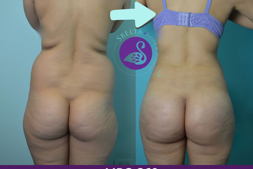 Lipoescultura antes y después - 880211
