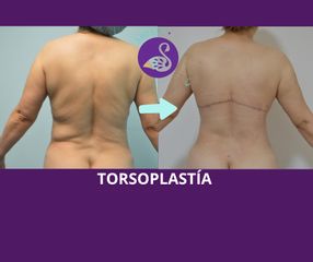 Torsoplastía - Dra. Jessica Ramírez Cadena