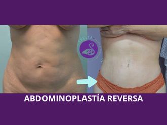 Abdominoplastia antes y después - 880216