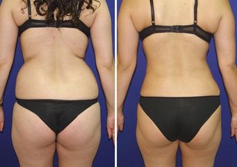 Hidrolipoclasia - Dr. Jesús Omar Carreón Terrones