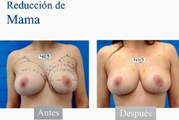 Reducción mamas - Dr. Jesús Omar Carreón Terrones