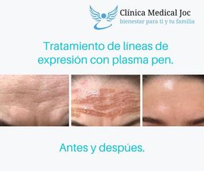 Plasmapen - Dr. Jesús Omar Carreón Terrones
