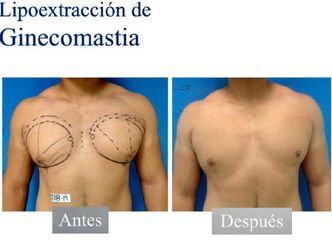 Ginecomastia - Dr. Jesús Omar Carreón Terrones