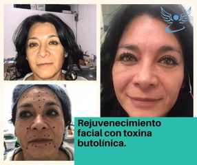 Toxina Botulínica  - Dr. Jesús Omar Carreón Terrones