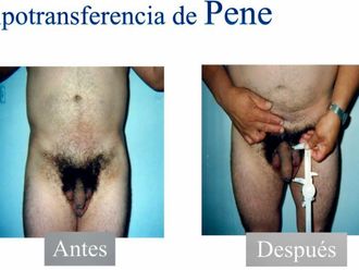 Alargamiento de pene antes y después - 841620