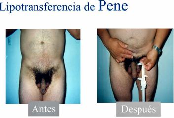 Alargamiento de pene - Dr. Jesús Omar Carreón Terrones