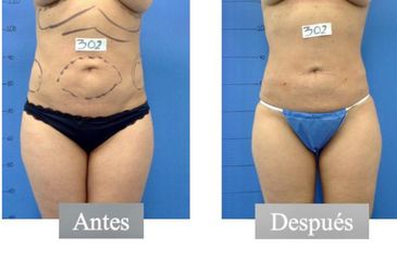 Liposucción - Dr. Jesús Omar Carreón Terrones