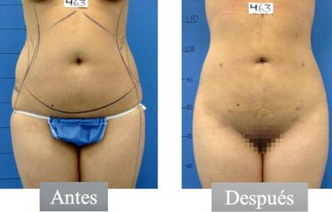 Liposucción - Dr. Jesús Omar Carreón Terrones
