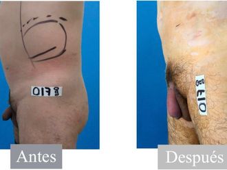 Alargamiento de pene antes y después - 841625