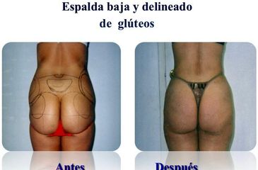 Gluteoplastia - Dr. Jesús Omar Carreón Terrones