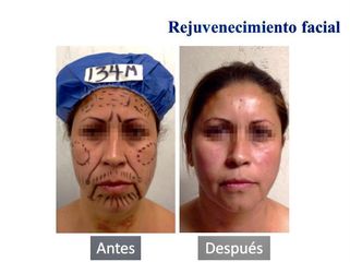 Rejuvenecimiento Facial - Dr. Jesús Omar Carreón Terrones