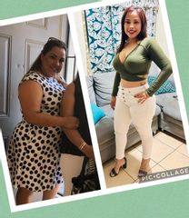 Mommy Makeover - Dr. Jesús Omar Carreón Terrones