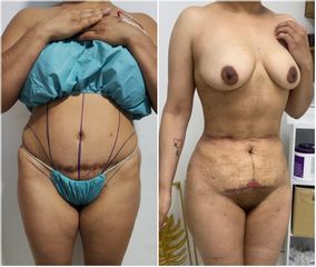 Abdominoplastia - Dr. Jesús Omar Carreón Terrones