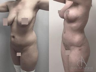 Antes y despues de abdominoplastia
