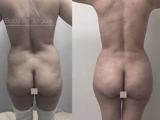 Antes y después de abdominoplastia