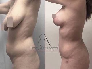 Antes y después de abdominoplastia