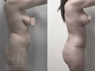 Antes y despues de abdominoplastia