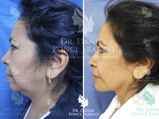 Antes y después de Lifting facial y de cuello