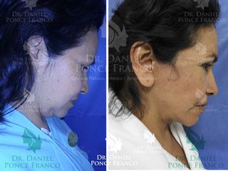 Antes y después de Cervicoplastía y lifting facial