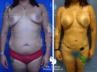 Antes y después de Liposucción e implantes de mama