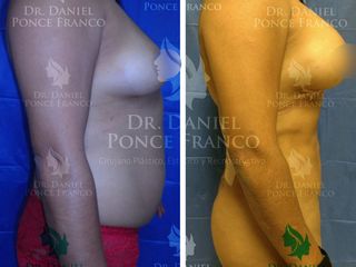 Antes y después de Liposucción e implantes de mama