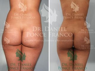 Antes y después de Aumento y lifting glúteo