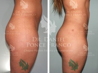 Antes y después de Gluteoplastía
