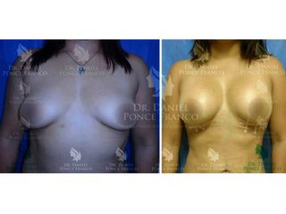 Mamoplastia de Aumento