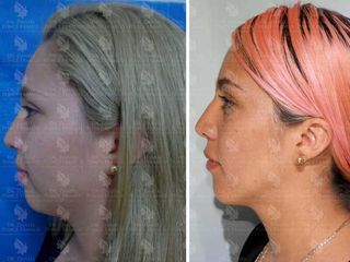 Antes y después de Liposucción de papada