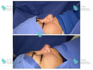Antes y después de Rinoplastia