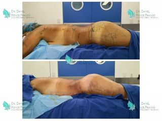 Antes y después de Lipoescultura