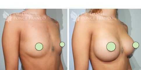 Antes y después de Aumento de busto