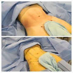 Lipo HD - Dr. Daniel Ponce Franco