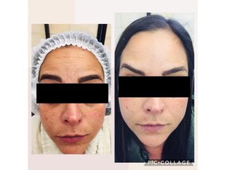 Antes y después de Aplicación de toxina botulínica 