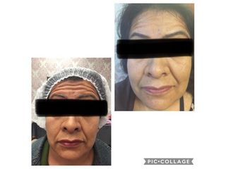 Antes y después de Aplicación de toxina botulínica 