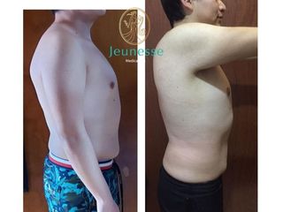 Antes y después de Radiofrecuencia 