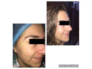 Antes y después de Rejuvenecimiento facial 