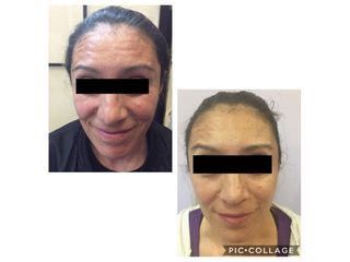 Antes y después de  Aplicación de toxina botulínica