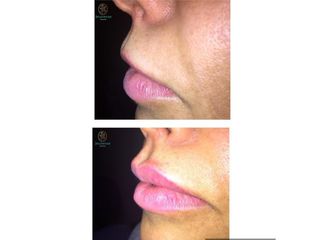 Antes y después de Aumento de labios