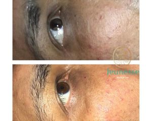 Antes y después de Tratamientos faciales 